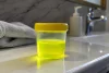 Urine jaune fluorescent : Causes, significations & Solutions