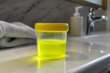 Urine jaune fluorescent : Causes, significations & Solutions